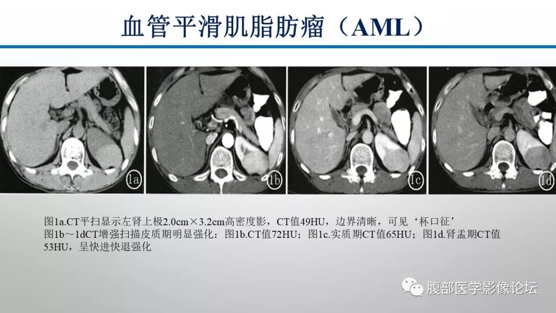 【病例】肾脏孤立性占位影像分析