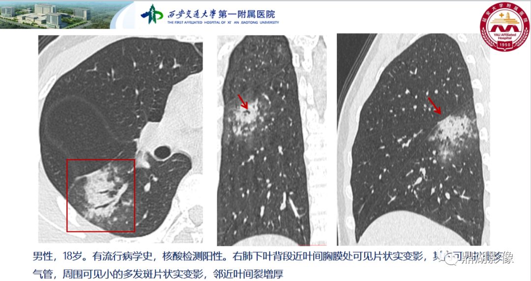 影像病理——COVID-19新型冠状病毒肺炎的“三字经”(附高清病例) 影像病理——COVID-19新型冠状病毒肺炎的“三字经”(附高清病例)