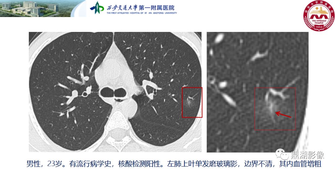 影像病理——COVID-19新型冠状病毒肺炎的“三字经”(附高清病例) 影像病理——COVID-19新型冠状病毒肺炎的“三字经”(附高清病例)