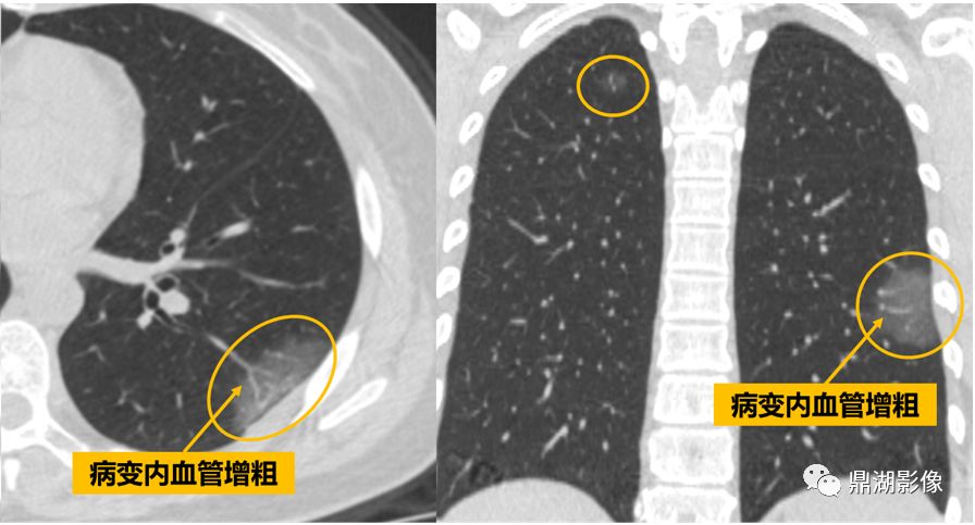 影像病理——COVID-19新型冠状病毒肺炎的“三字经”(附高清病例) 影像病理——COVID-19新型冠状病毒肺炎的“三字经”(附高清病例)