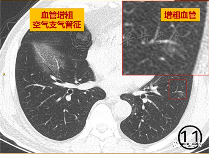 影像病理——COVID-19新型冠状病毒肺炎的“三字经”(附高清病例) 影像病理——COVID-19新型冠状病毒肺炎的“三字经”(附高清病例)