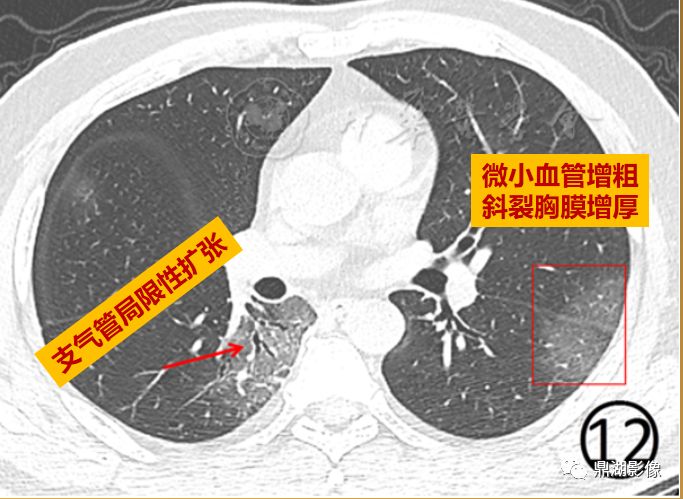 影像病理——COVID-19新型冠状病毒肺炎的“三字经”(附高清病例) 影像病理——COVID-19新型冠状病毒肺炎的“三字经”(附高清病例)