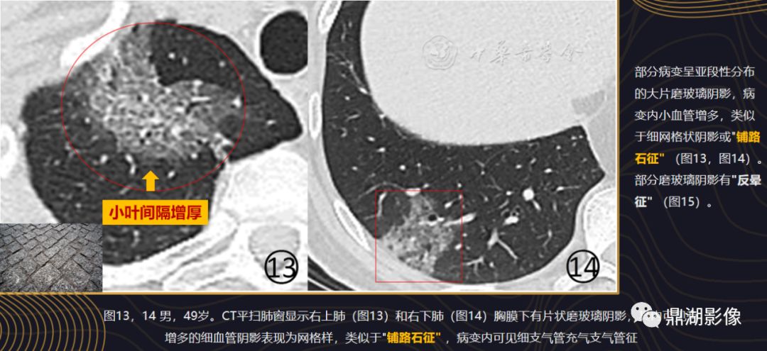 影像病理——COVID-19新型冠状病毒肺炎的“三字经”(附高清病例) 影像病理——COVID-19新型冠状病毒肺炎的“三字经”(附高清病例)