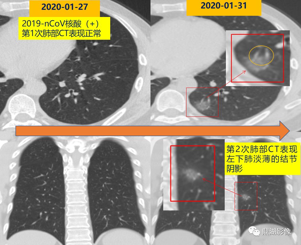 影像病理——COVID-19新型冠状病毒肺炎的“三字经”(附高清病例) 影像病理——COVID-19新型冠状病毒肺炎的“三字经”(附高清病例)