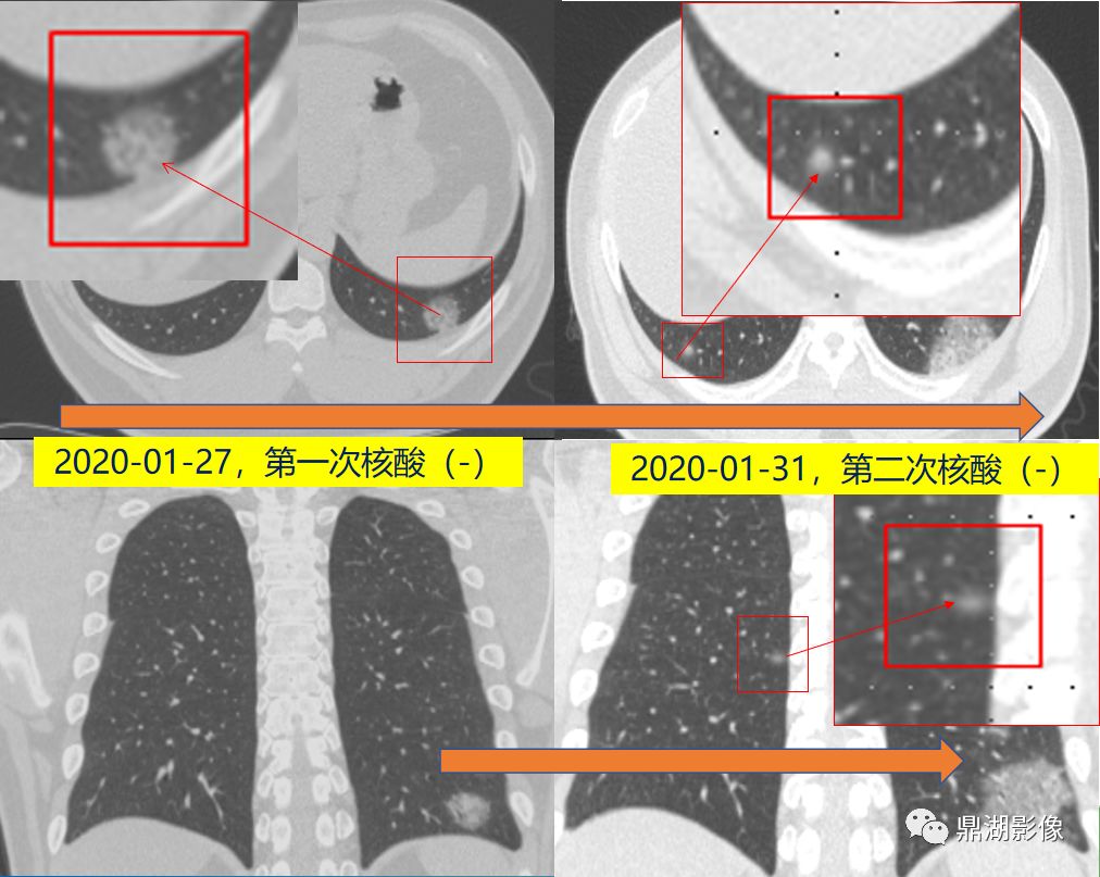 影像病理——COVID-19新型冠状病毒肺炎的“三字经”(附高清病例) 影像病理——COVID-19新型冠状病毒肺炎的“三字经”(附高清病例)