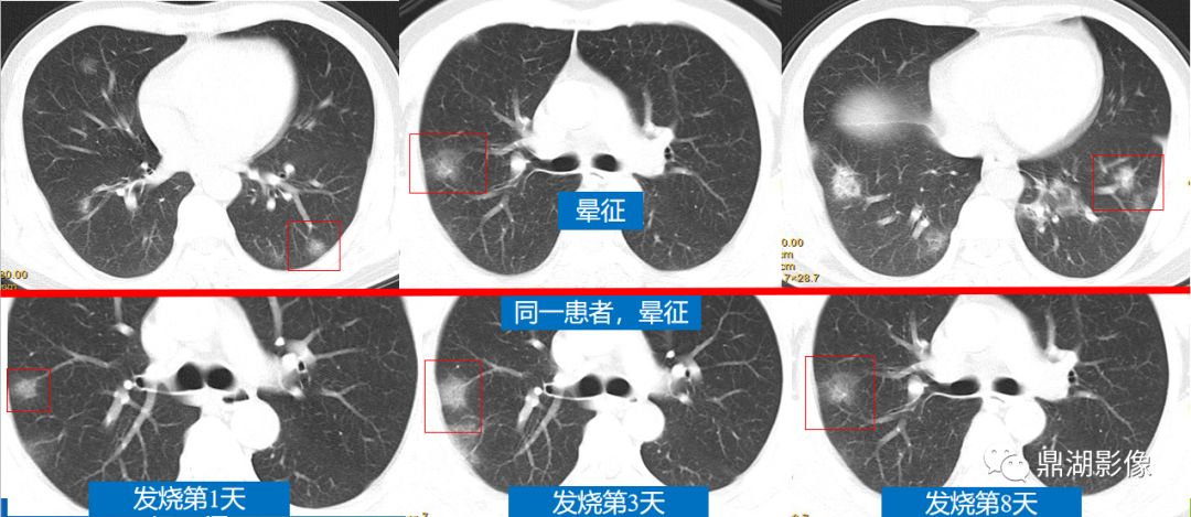 影像病理——COVID-19新型冠状病毒肺炎的“三字经”(附高清病例) 影像病理——COVID-19新型冠状病毒肺炎的“三字经”(附高清病例)