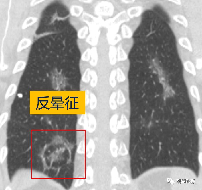 影像病理——COVID-19新型冠状病毒肺炎的“三字经”(附高清病例) 影像病理——COVID-19新型冠状病毒肺炎的“三字经”(附高清病例)