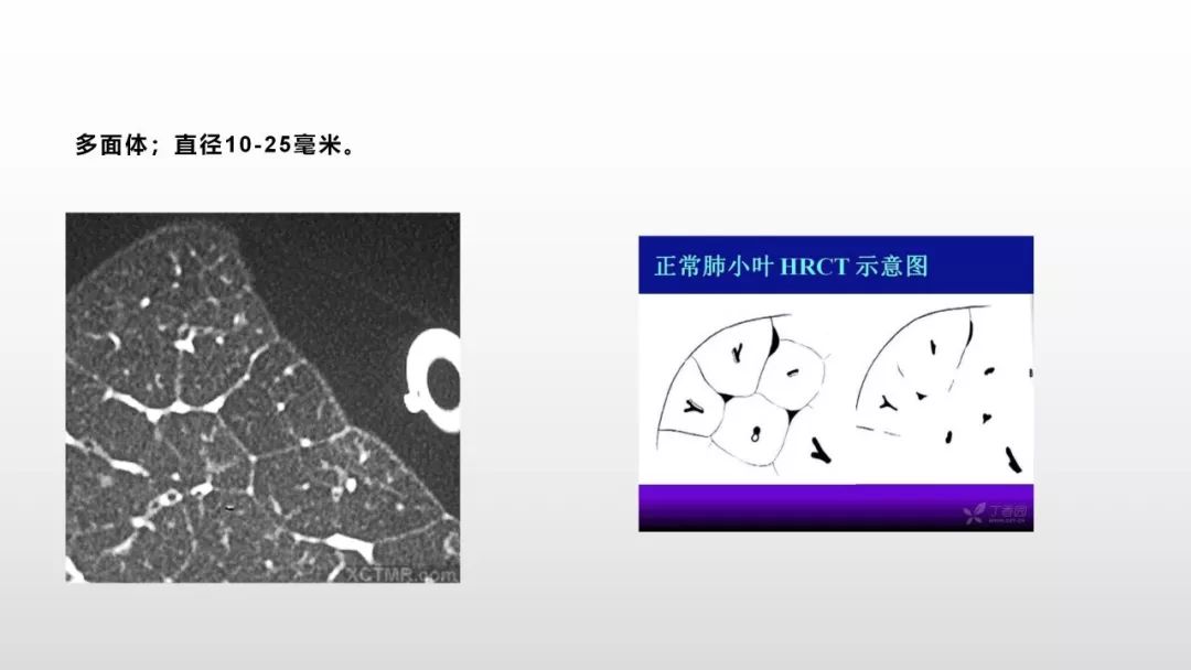 影像病理——COVID-19新型冠状病毒肺炎的“三字经”(附高清病例) 影像病理——COVID-19新型冠状病毒肺炎的“三字经”(附高清病例)