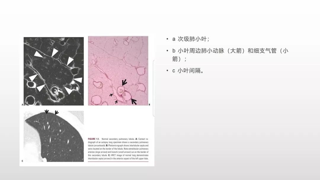 影像病理——COVID-19新型冠状病毒肺炎的“三字经”(附高清病例) 影像病理——COVID-19新型冠状病毒肺炎的“三字经”(附高清病例)
