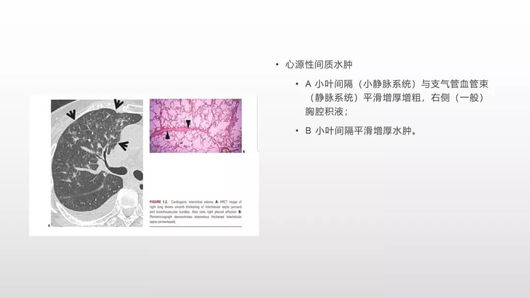 影像病理——COVID-19新型冠状病毒肺炎的“三字经”(附高清病例) 影像病理——COVID-19新型冠状病毒肺炎的“三字经”(附高清病例)
