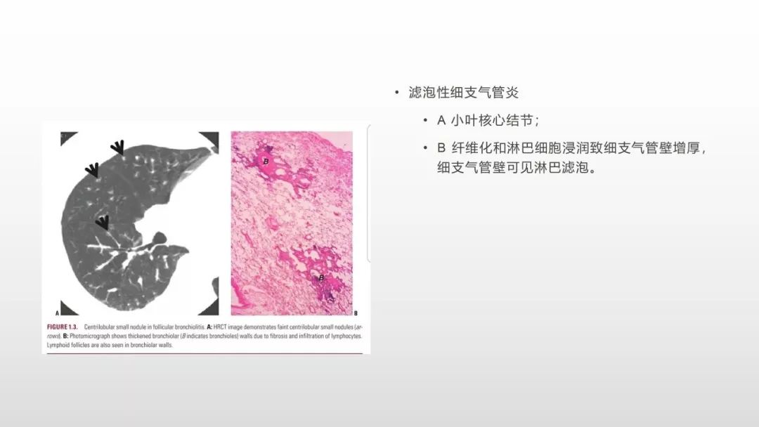 影像病理——COVID-19新型冠状病毒肺炎的“三字经”(附高清病例) 影像病理——COVID-19新型冠状病毒肺炎的“三字经”(附高清病例)