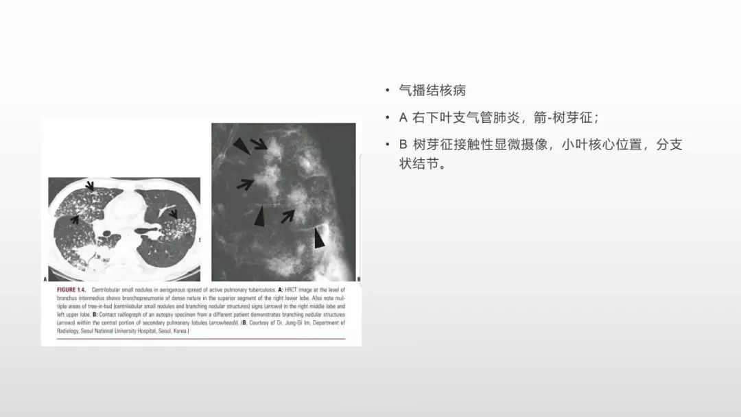 影像病理——COVID-19新型冠状病毒肺炎的“三字经”(附高清病例) 影像病理——COVID-19新型冠状病毒肺炎的“三字经”(附高清病例)