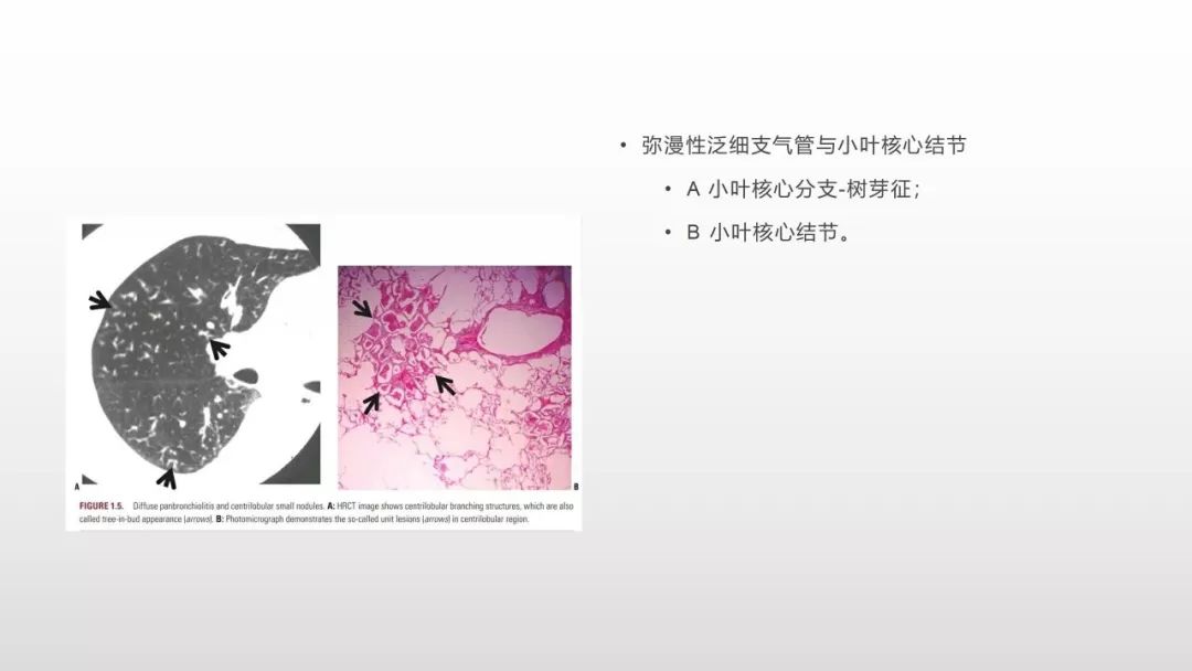 影像病理——COVID-19新型冠状病毒肺炎的“三字经”(附高清病例) 影像病理——COVID-19新型冠状病毒肺炎的“三字经”(附高清病例)