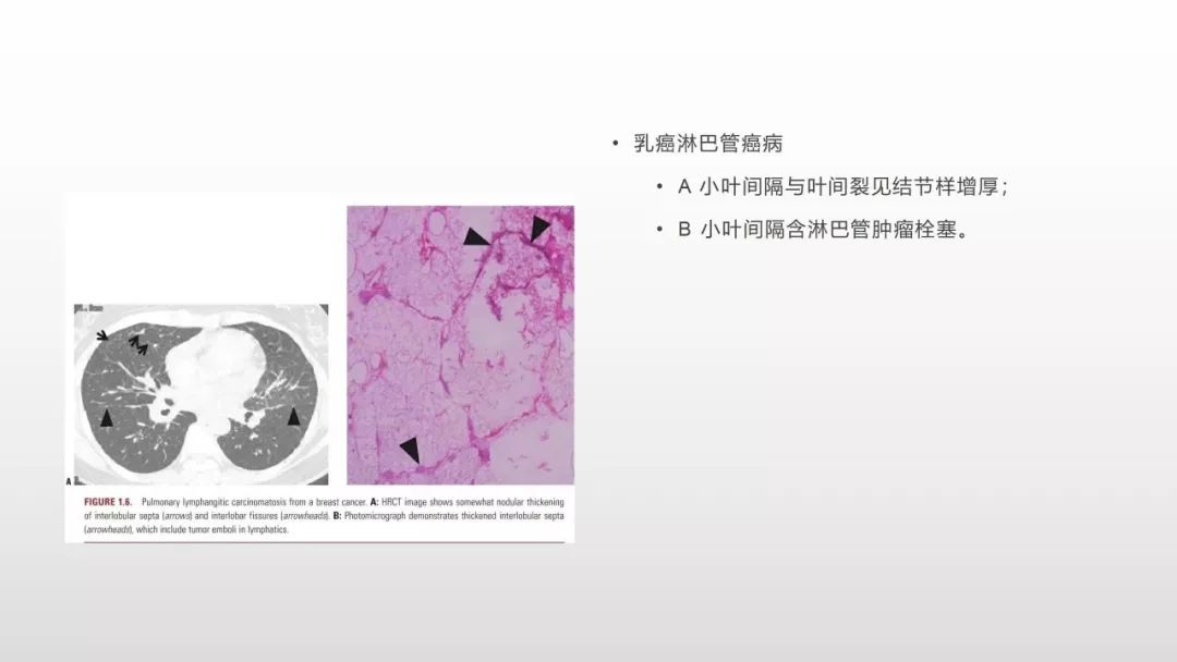 影像病理——COVID-19新型冠状病毒肺炎的“三字经”(附高清病例) 影像病理——COVID-19新型冠状病毒肺炎的“三字经”(附高清病例)