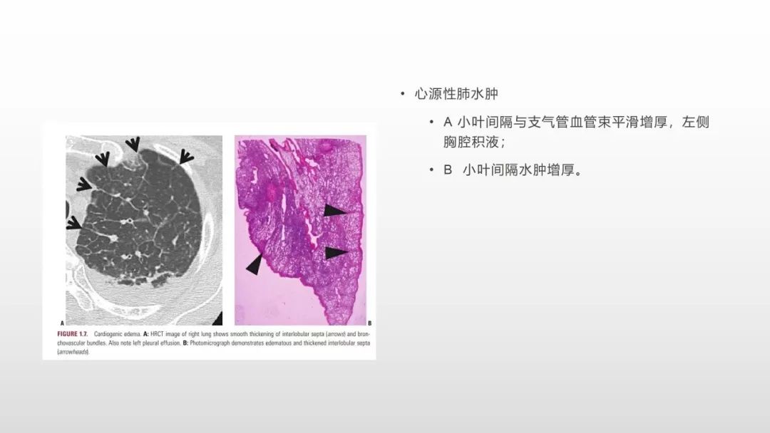 影像病理——COVID-19新型冠状病毒肺炎的“三字经”(附高清病例) 影像病理——COVID-19新型冠状病毒肺炎的“三字经”(附高清病例)