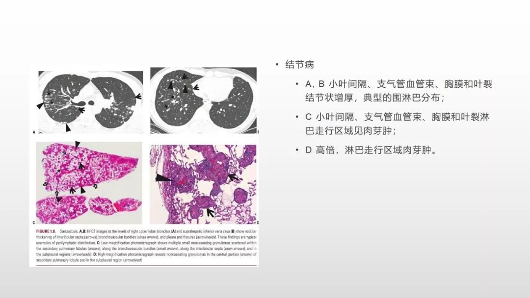 影像病理——COVID-19新型冠状病毒肺炎的“三字经”(附高清病例) 影像病理——COVID-19新型冠状病毒肺炎的“三字经”(附高清病例)
