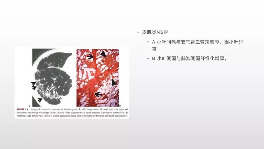 影像病理——COVID-19新型冠状病毒肺炎的“三字经”(附高清病例) 影像病理——COVID-19新型冠状病毒肺炎的“三字经”(附高清病例)