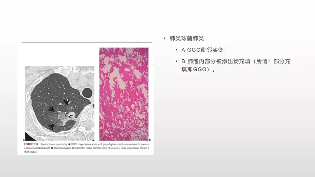 影像病理——COVID-19新型冠状病毒肺炎的“三字经”(附高清病例) 影像病理——COVID-19新型冠状病毒肺炎的“三字经”(附高清病例)