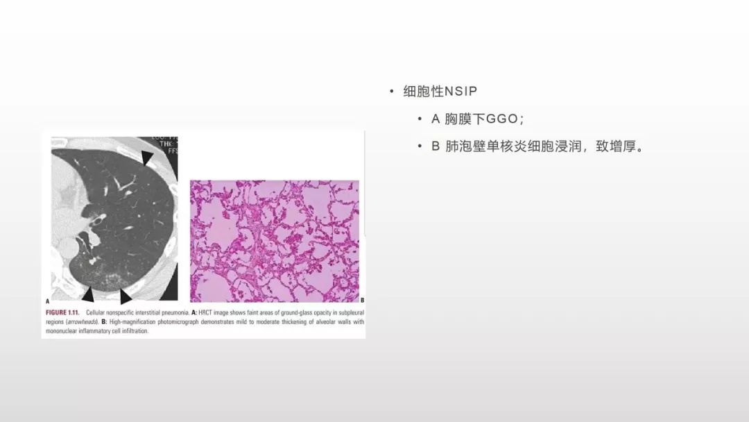 影像病理——COVID-19新型冠状病毒肺炎的“三字经”(附高清病例) 影像病理——COVID-19新型冠状病毒肺炎的“三字经”(附高清病例)