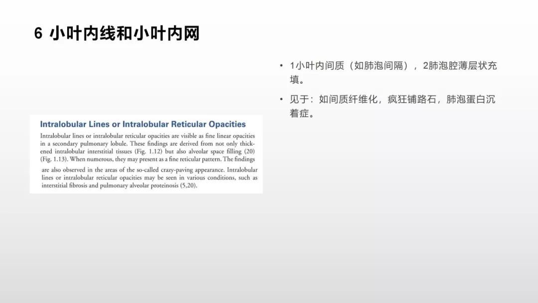 影像病理——COVID-19新型冠状病毒肺炎的“三字经”(附高清病例) 影像病理——COVID-19新型冠状病毒肺炎的“三字经”(附高清病例)