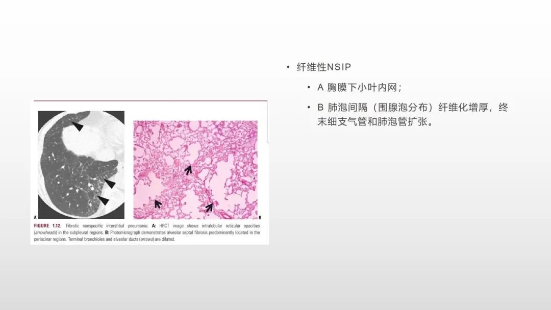 影像病理——COVID-19新型冠状病毒肺炎的“三字经”(附高清病例) 影像病理——COVID-19新型冠状病毒肺炎的“三字经”(附高清病例)