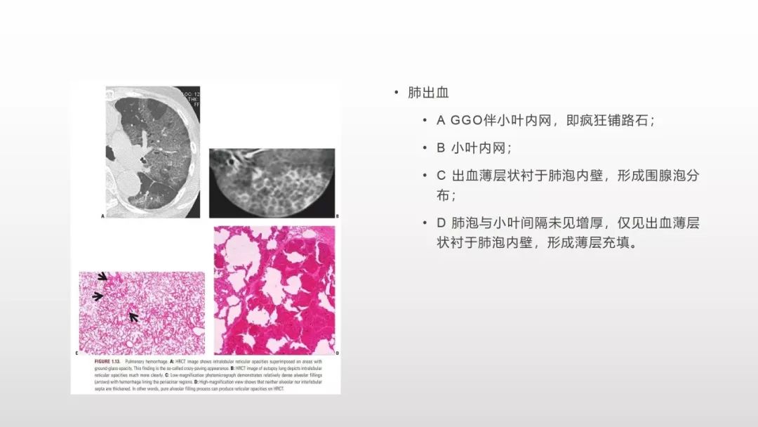 影像病理——COVID-19新型冠状病毒肺炎的“三字经”(附高清病例) 影像病理——COVID-19新型冠状病毒肺炎的“三字经”(附高清病例)