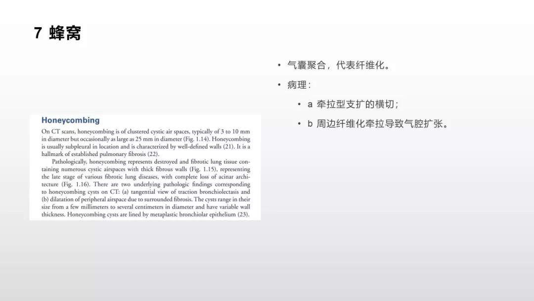 影像病理——COVID-19新型冠状病毒肺炎的“三字经”(附高清病例) 影像病理——COVID-19新型冠状病毒肺炎的“三字经”(附高清病例)