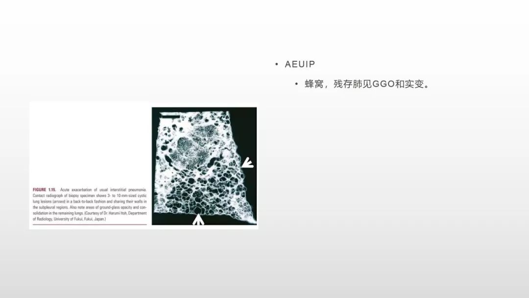 影像病理——COVID-19新型冠状病毒肺炎的“三字经”(附高清病例) 影像病理——COVID-19新型冠状病毒肺炎的“三字经”(附高清病例)
