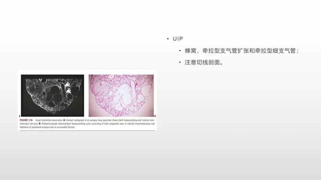 影像病理——COVID-19新型冠状病毒肺炎的“三字经”(附高清病例) 影像病理——COVID-19新型冠状病毒肺炎的“三字经”(附高清病例)
