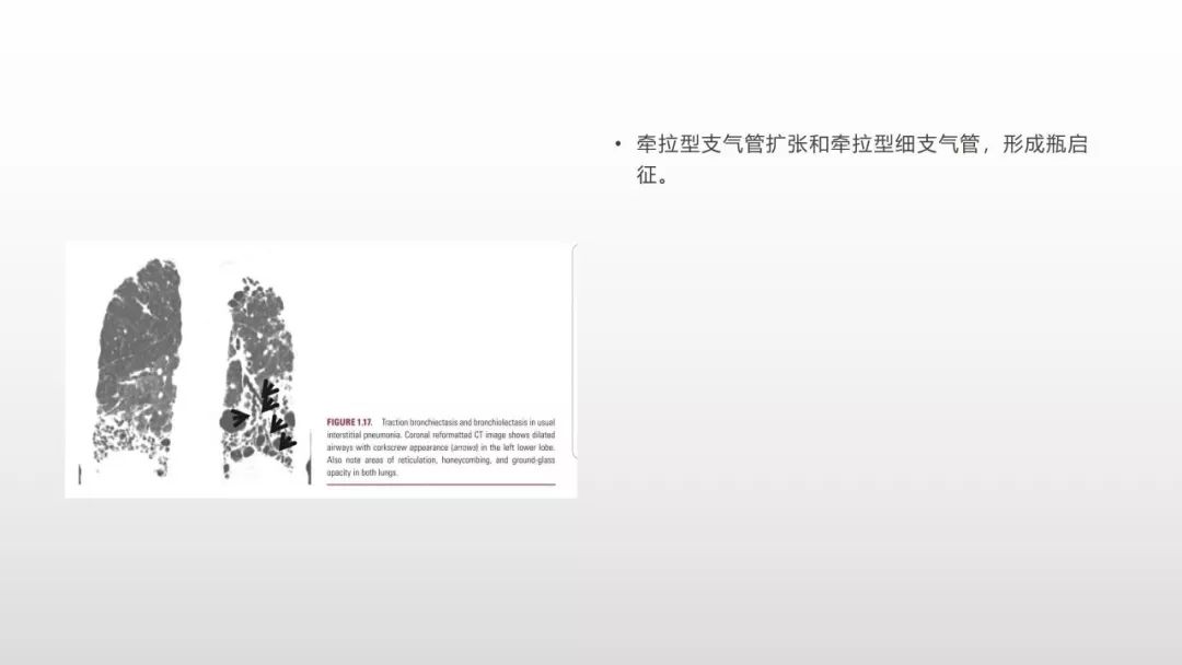 影像病理——COVID-19新型冠状病毒肺炎的“三字经”(附高清病例) 影像病理——COVID-19新型冠状病毒肺炎的“三字经”(附高清病例)