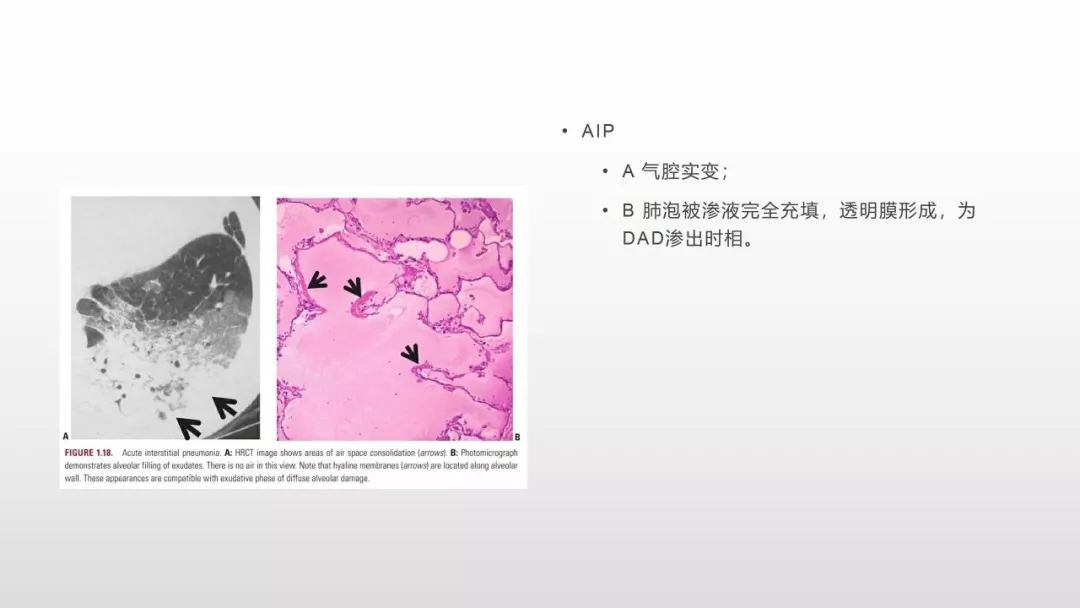 影像病理——COVID-19新型冠状病毒肺炎的“三字经”(附高清病例) 影像病理——COVID-19新型冠状病毒肺炎的“三字经”(附高清病例)
