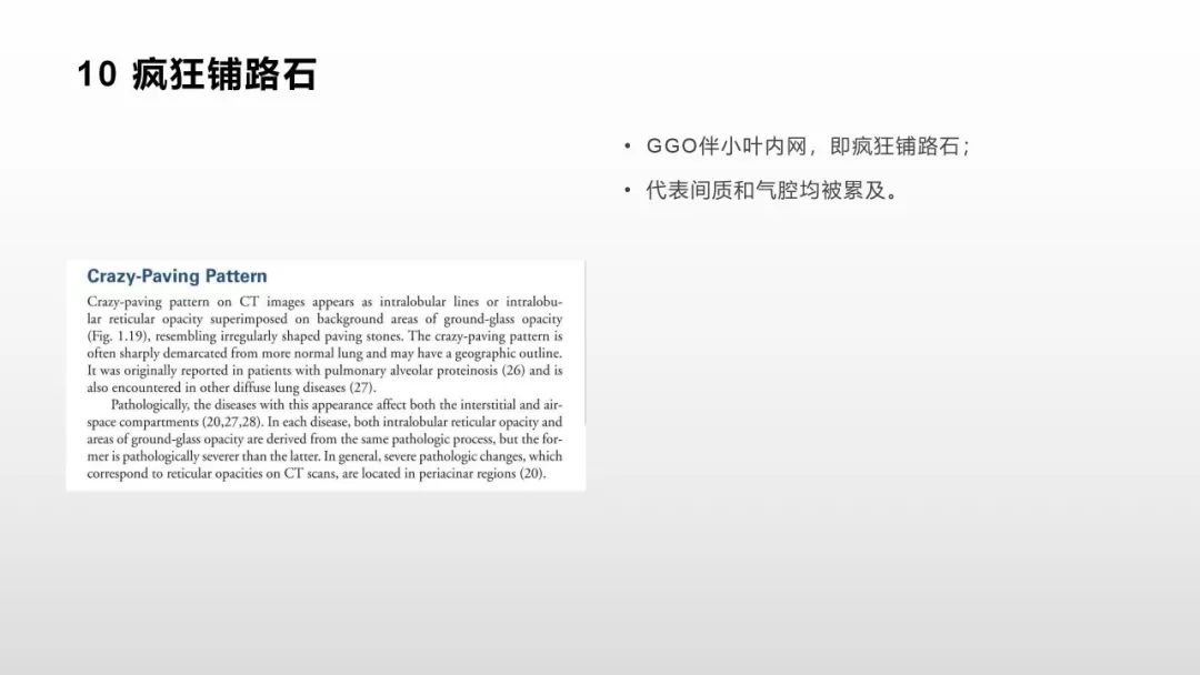 影像病理——COVID-19新型冠状病毒肺炎的“三字经”(附高清病例) 影像病理——COVID-19新型冠状病毒肺炎的“三字经”(附高清病例)