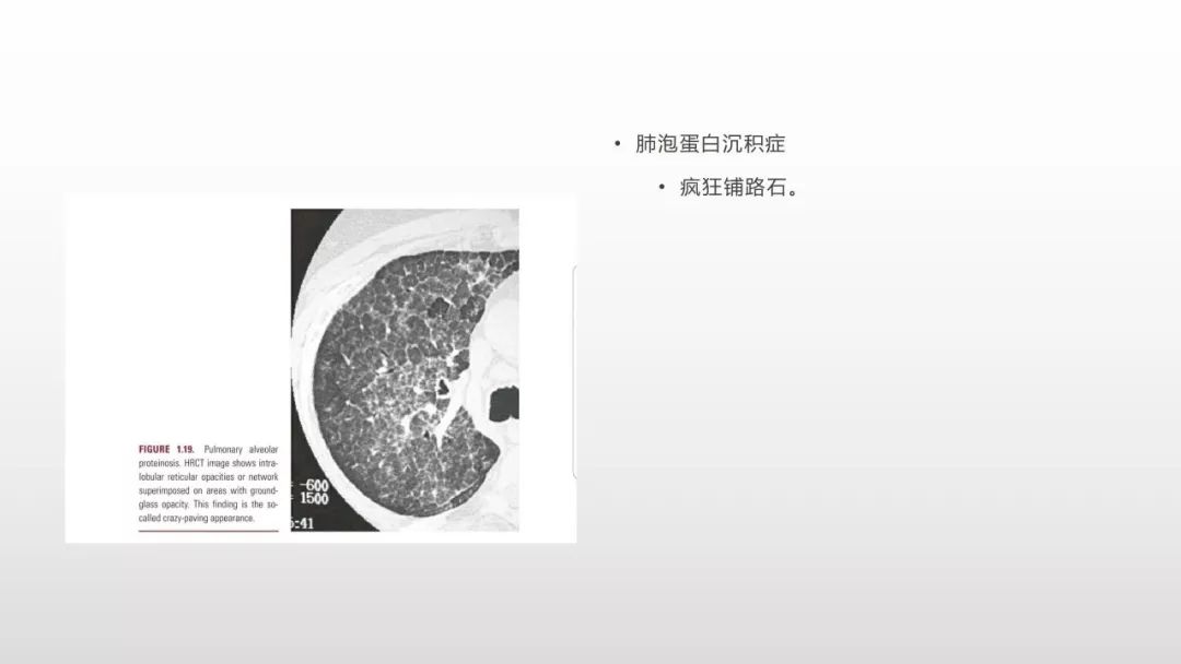 影像病理——COVID-19新型冠状病毒肺炎的“三字经”(附高清病例) 影像病理——COVID-19新型冠状病毒肺炎的“三字经”(附高清病例)