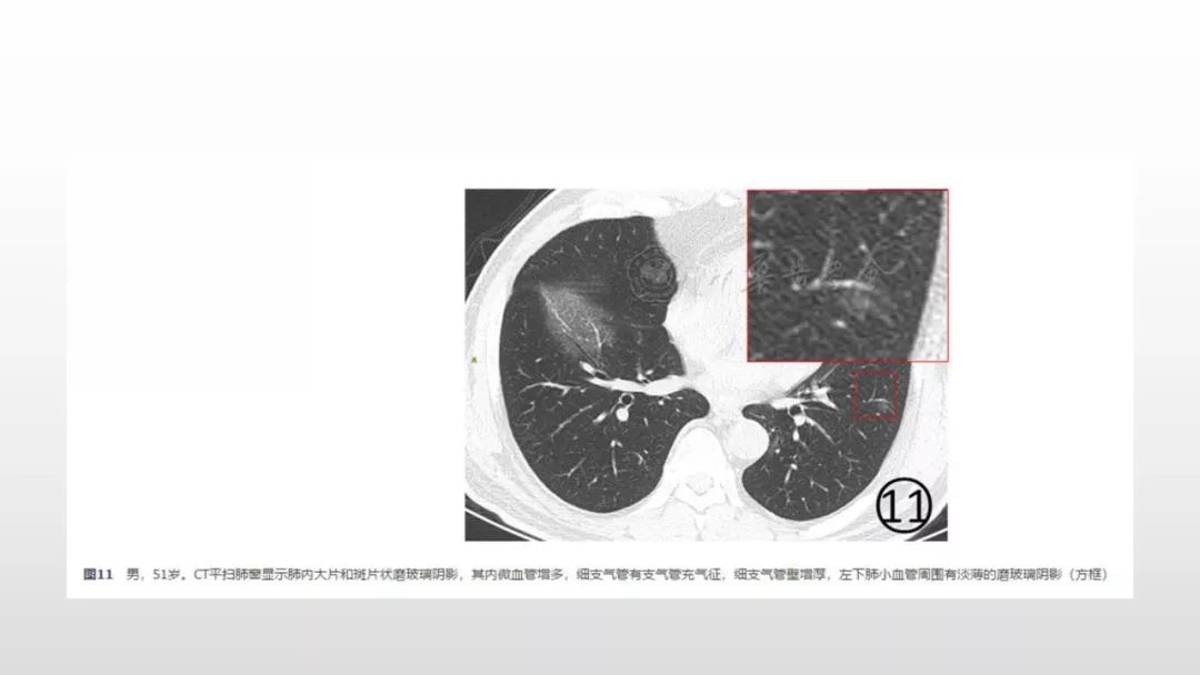 影像病理——COVID-19新型冠状病毒肺炎的“三字经”(附高清病例) 影像病理——COVID-19新型冠状病毒肺炎的“三字经”(附高清病例)
