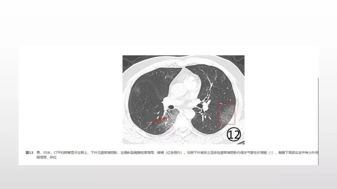 影像病理——COVID-19新型冠状病毒肺炎的“三字经”(附高清病例) 影像病理——COVID-19新型冠状病毒肺炎的“三字经”(附高清病例)