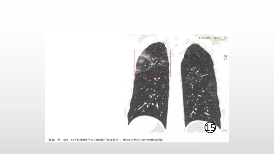 影像病理——COVID-19新型冠状病毒肺炎的“三字经”(附高清病例) 影像病理——COVID-19新型冠状病毒肺炎的“三字经”(附高清病例)