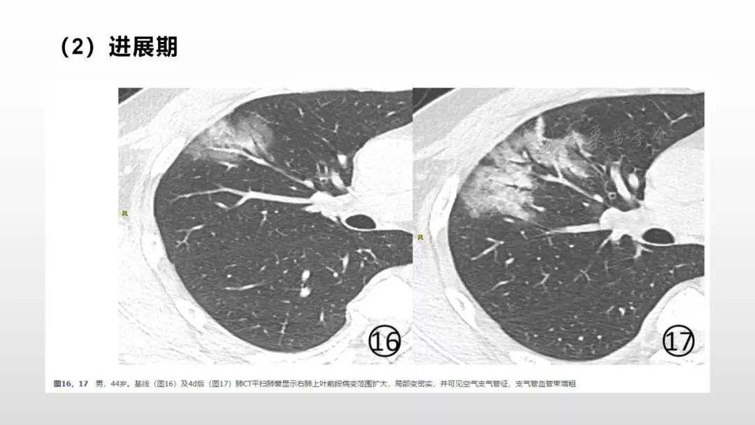 影像病理——COVID-19新型冠状病毒肺炎的“三字经”(附高清病例) 影像病理——COVID-19新型冠状病毒肺炎的“三字经”(附高清病例)
