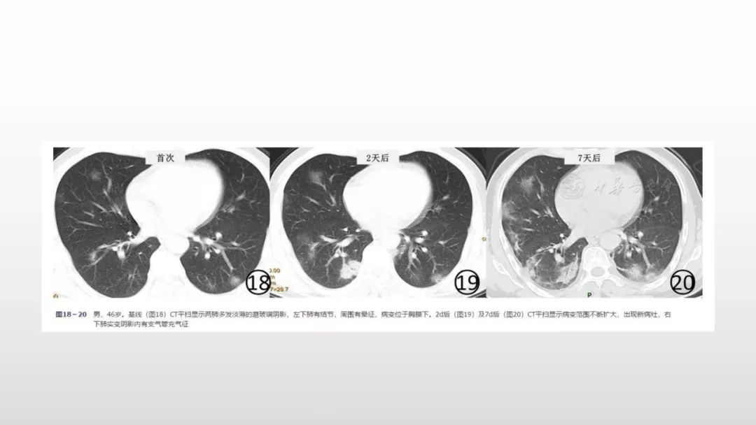 影像病理——COVID-19新型冠状病毒肺炎的“三字经”(附高清病例) 影像病理——COVID-19新型冠状病毒肺炎的“三字经”(附高清病例)