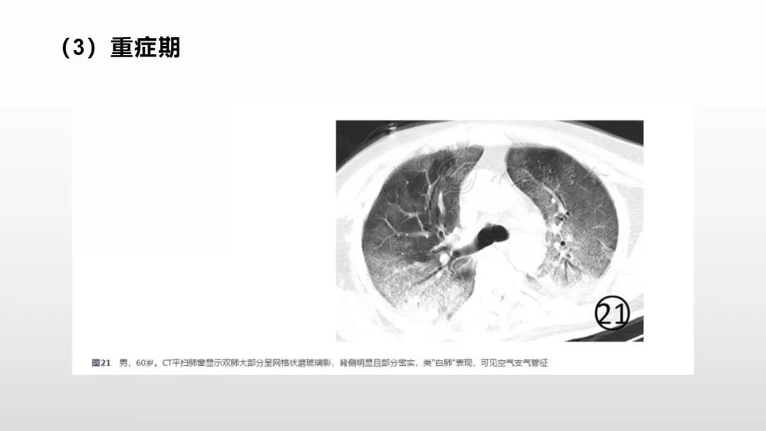影像病理——COVID-19新型冠状病毒肺炎的“三字经”(附高清病例) 影像病理——COVID-19新型冠状病毒肺炎的“三字经”(附高清病例)