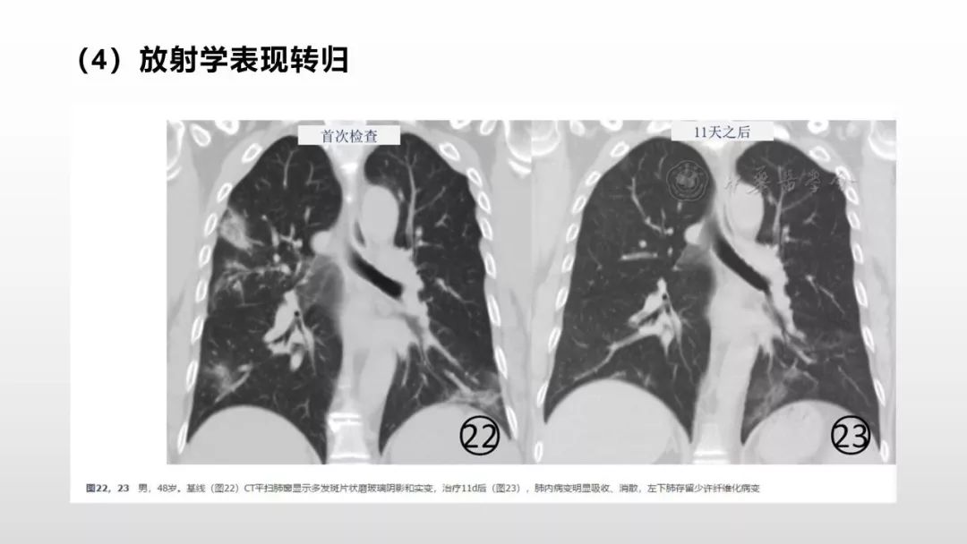 影像病理——COVID-19新型冠状病毒肺炎的“三字经”(附高清病例) 影像病理——COVID-19新型冠状病毒肺炎的“三字经”(附高清病例)