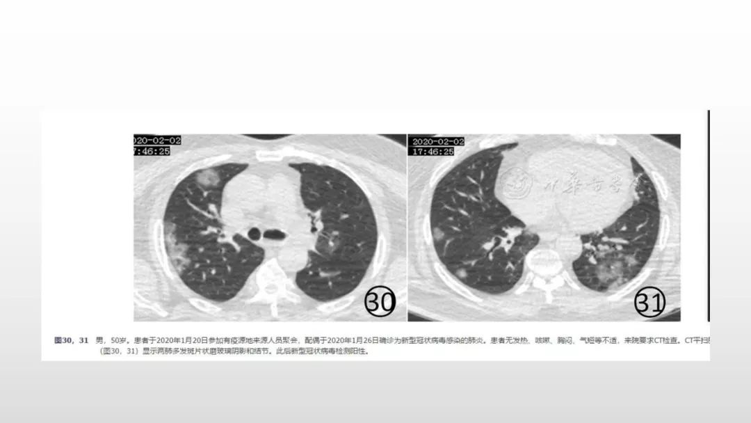 影像病理——COVID-19新型冠状病毒肺炎的“三字经”(附高清病例) 影像病理——COVID-19新型冠状病毒肺炎的“三字经”(附高清病例)