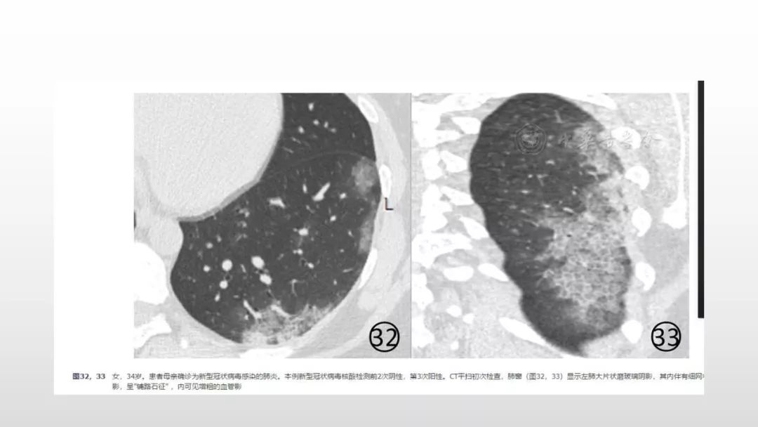 影像病理——COVID-19新型冠状病毒肺炎的“三字经”(附高清病例) 影像病理——COVID-19新型冠状病毒肺炎的“三字经”(附高清病例)