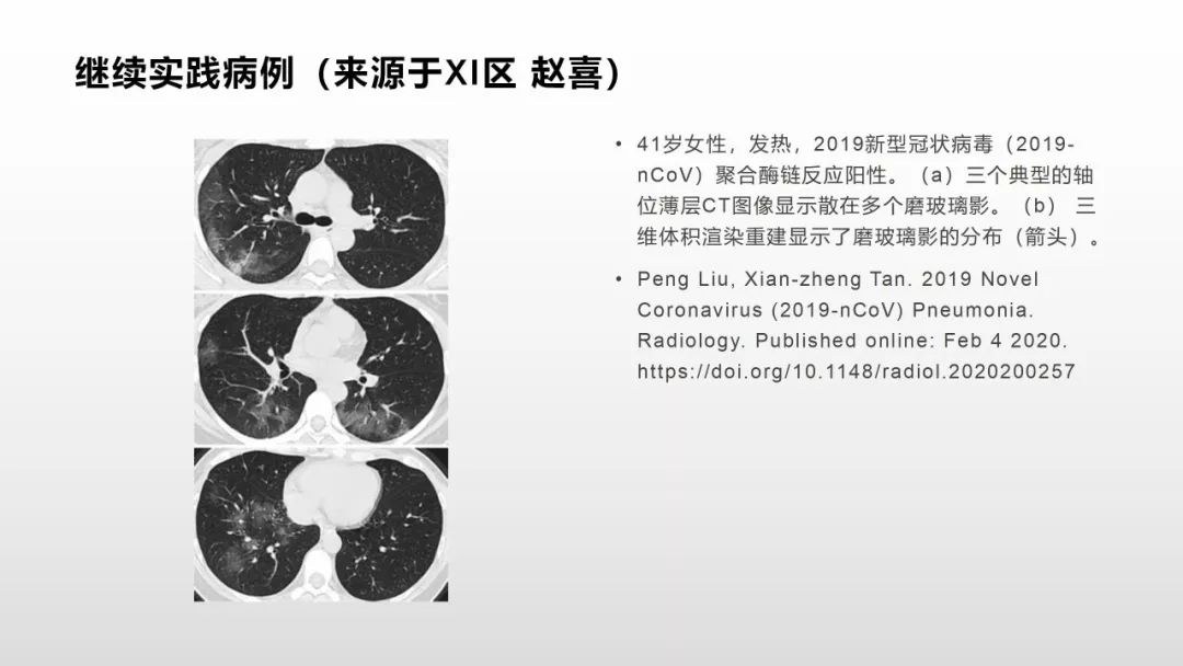 影像病理——COVID-19新型冠状病毒肺炎的“三字经”(附高清病例) 影像病理——COVID-19新型冠状病毒肺炎的“三字经”(附高清病例)