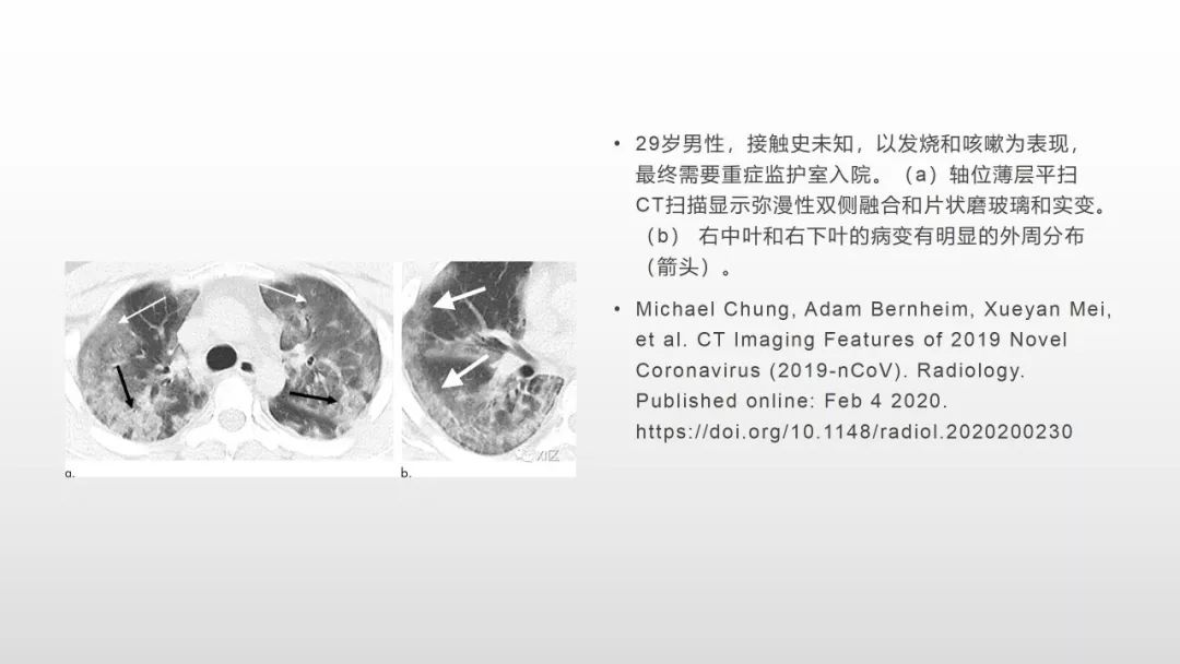 影像病理——COVID-19新型冠状病毒肺炎的“三字经”(附高清病例) 影像病理——COVID-19新型冠状病毒肺炎的“三字经”(附高清病例)