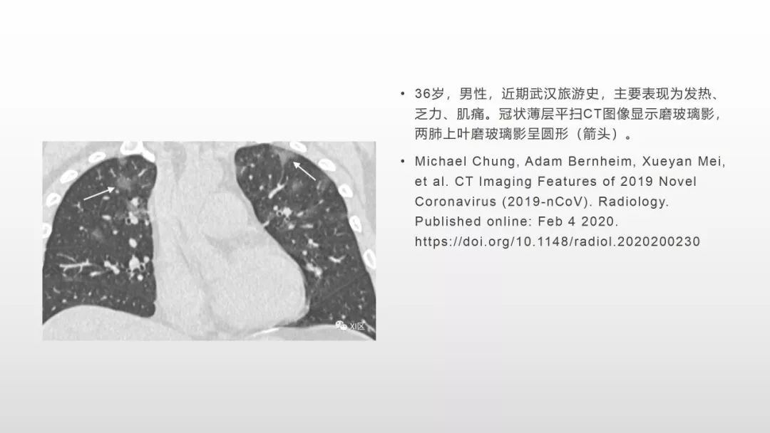 影像病理——COVID-19新型冠状病毒肺炎的“三字经”(附高清病例) 影像病理——COVID-19新型冠状病毒肺炎的“三字经”(附高清病例)