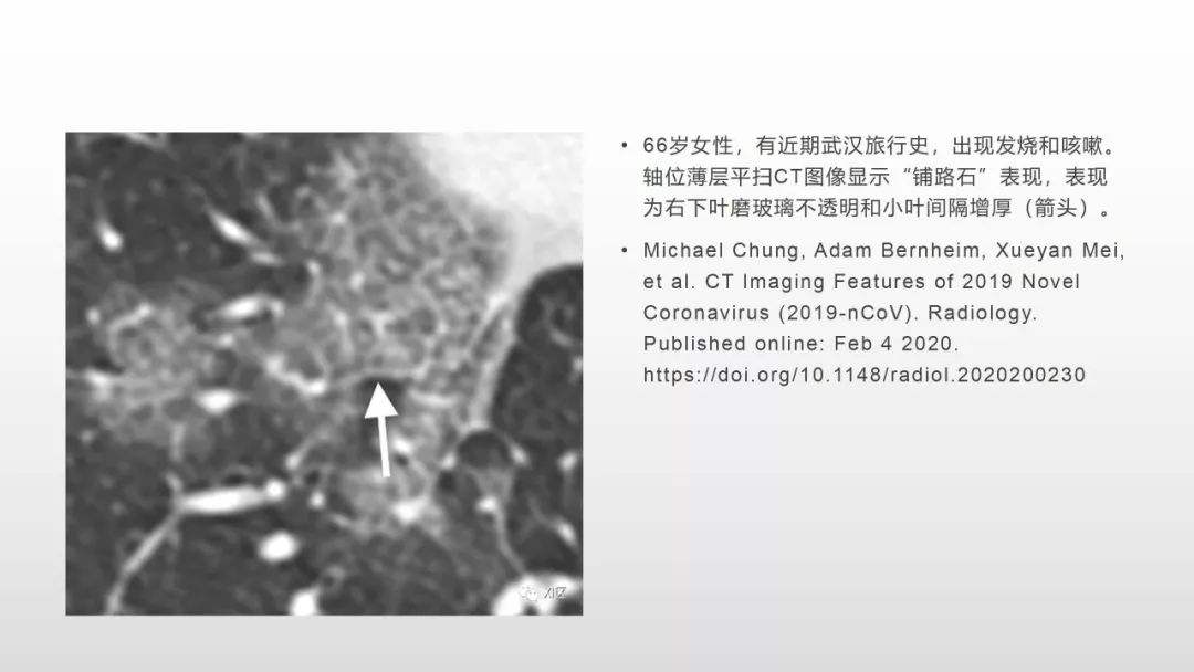 影像病理——COVID-19新型冠状病毒肺炎的“三字经”(附高清病例) 影像病理——COVID-19新型冠状病毒肺炎的“三字经”(附高清病例)