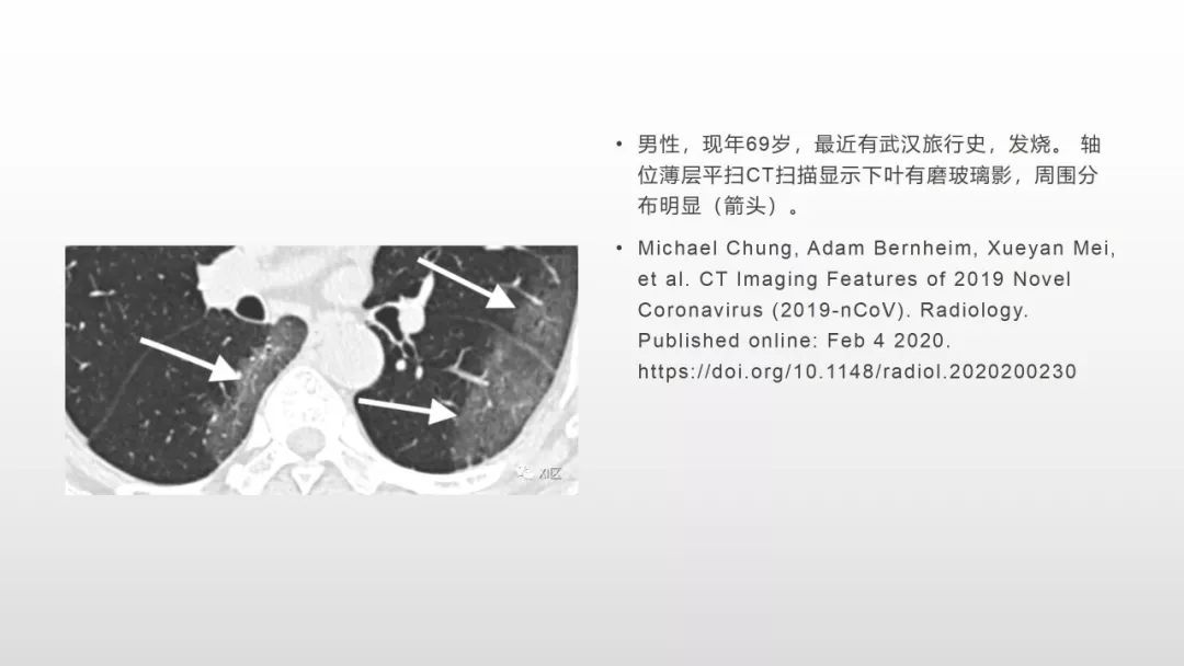 影像病理——COVID-19新型冠状病毒肺炎的“三字经”(附高清病例) 影像病理——COVID-19新型冠状病毒肺炎的“三字经”(附高清病例)