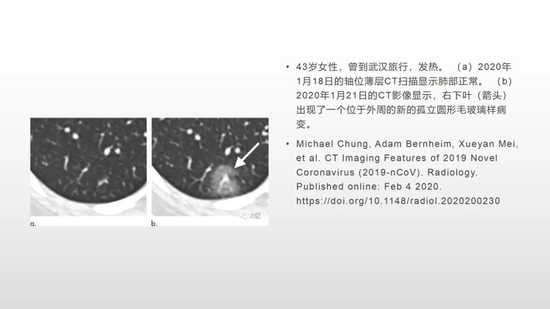 影像病理——COVID-19新型冠状病毒肺炎的“三字经”(附高清病例) 影像病理——COVID-19新型冠状病毒肺炎的“三字经”(附高清病例)