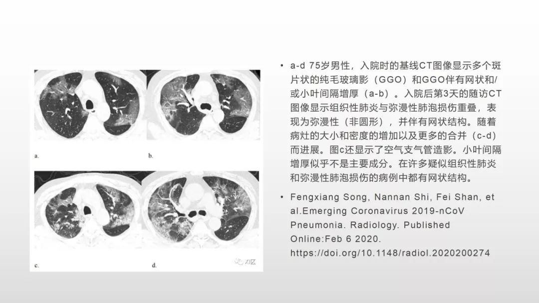 影像病理——COVID-19新型冠状病毒肺炎的“三字经”(附高清病例) 影像病理——COVID-19新型冠状病毒肺炎的“三字经”(附高清病例)