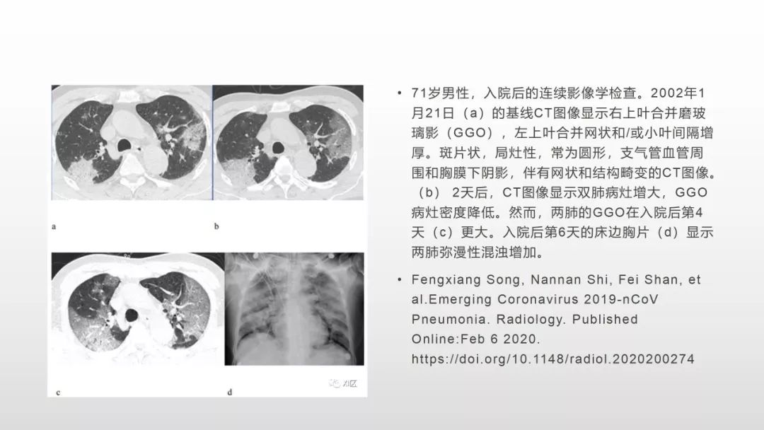 影像病理——COVID-19新型冠状病毒肺炎的“三字经”(附高清病例) 影像病理——COVID-19新型冠状病毒肺炎的“三字经”(附高清病例)